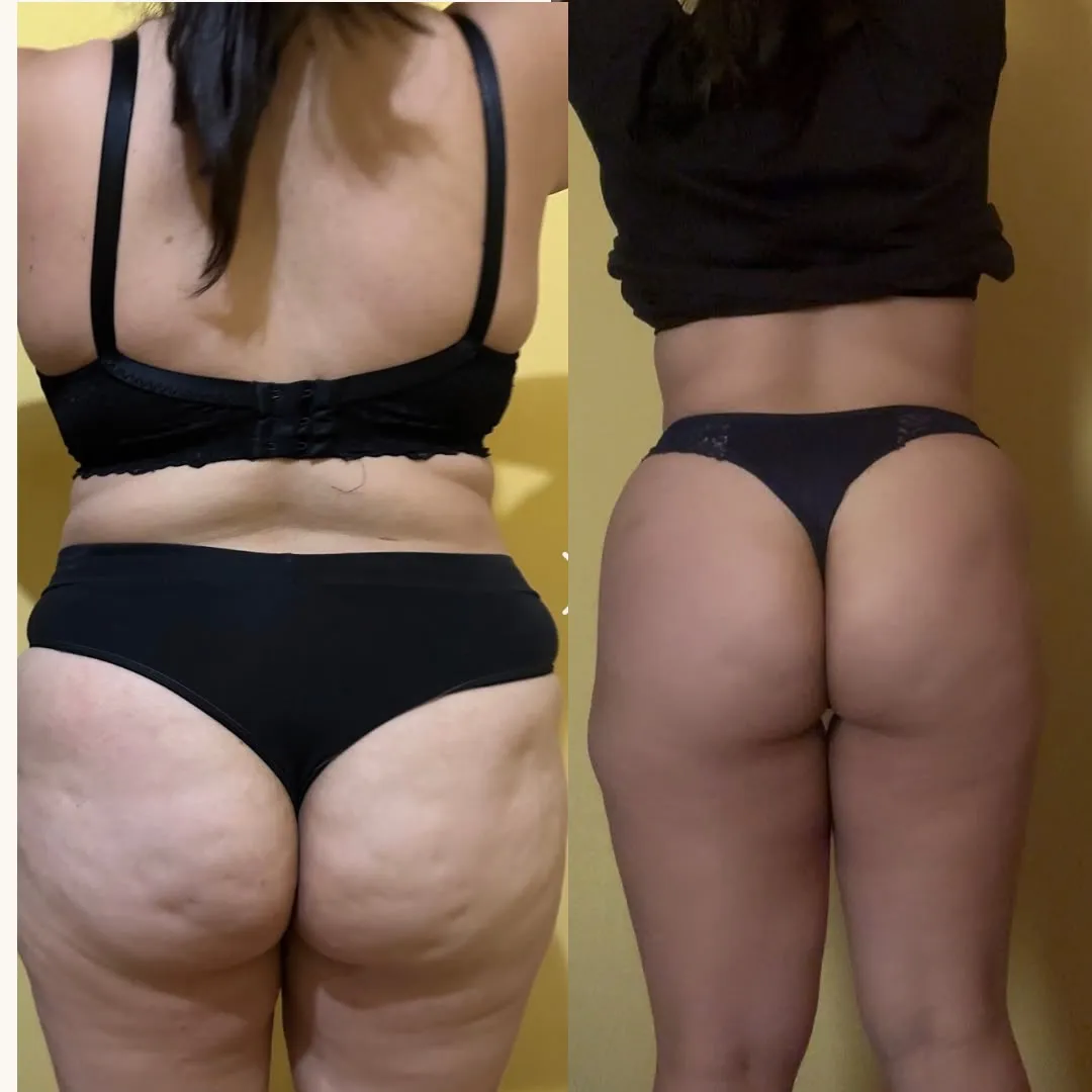 Antes e Depois